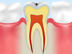 C0初期虫歯