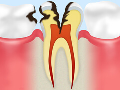 C3歯の神経の虫歯
