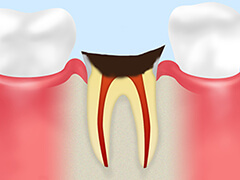 C4末期虫歯