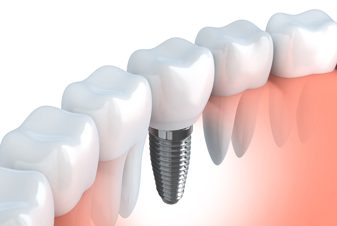 失った歯の機能と見た目を回復させるインプラント治療