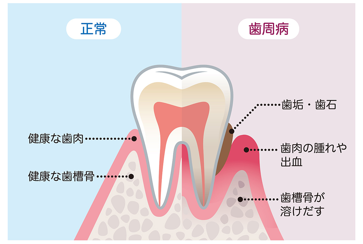 世界でもっとも患者数が多い歯周病