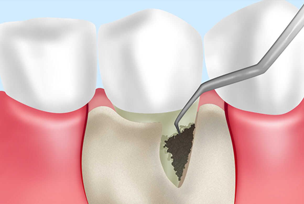当院の歯周外科治療