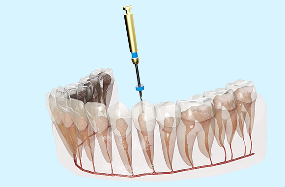 歯の根っこの治療根管治療