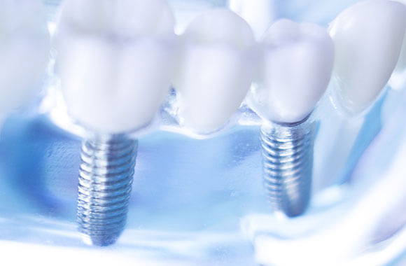 歯の機能と見た目を取り戻すインプラント治療