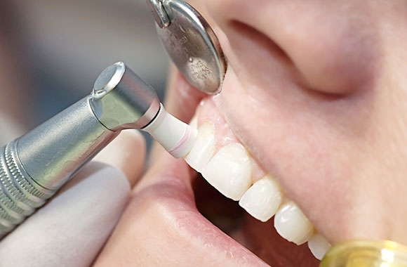定期的なメンテナンスで予防を予防歯科