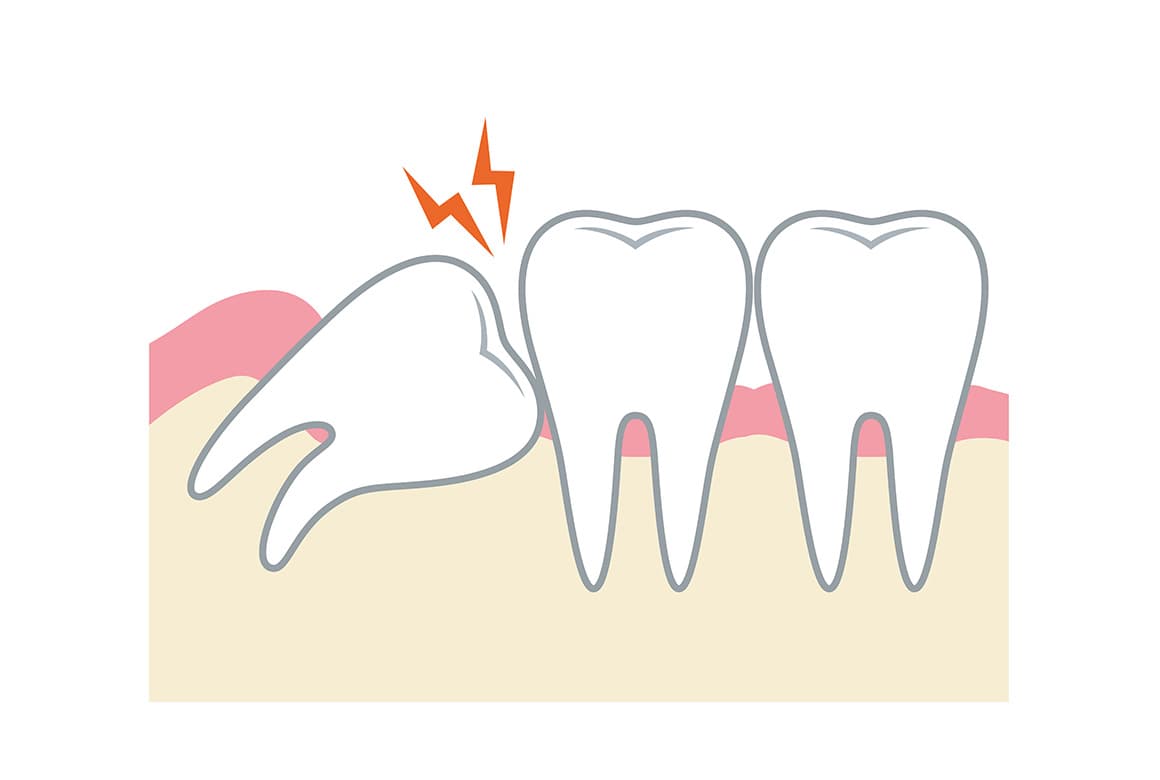 親知らずを抜歯した方がよい理由